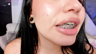 avascott_ 03/29/2026 braces