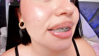 avascott_ 03/29/2026 braces